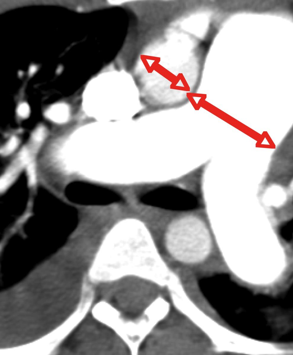 Fig. 2: Dilated pulmonary artery in a patient with diffuse