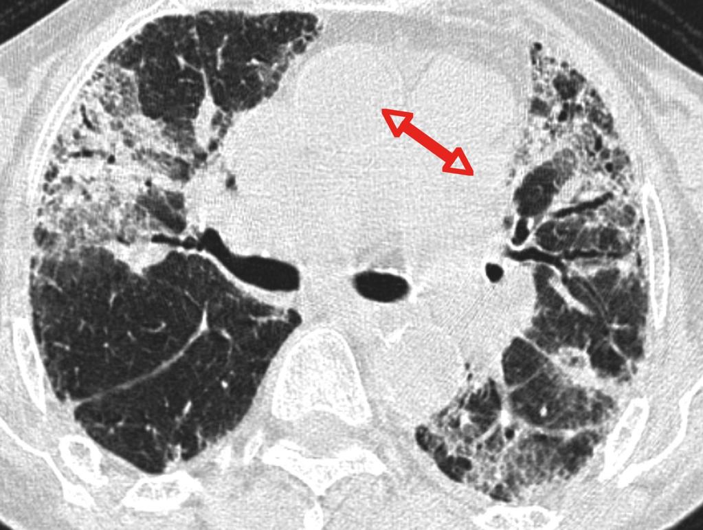 Fig. 3: Dilated pulmonary artery on axial CT Pulmonary Angiographic imaging. Note the ratio of the diameter of the pulmonary artery to the adjacent ascending aorta is greater than 1. Fig.