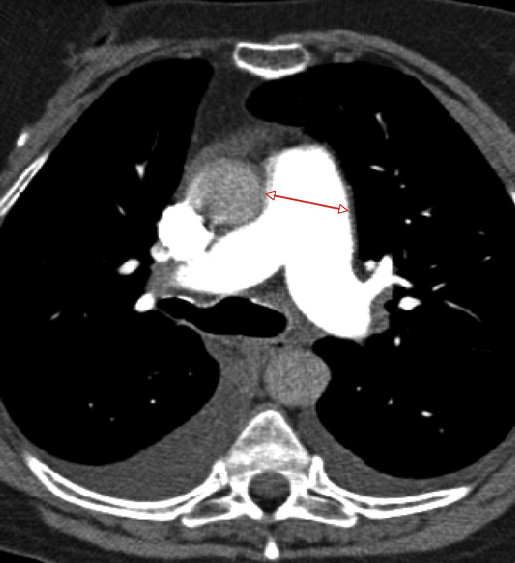 Fig. 1: Measurement of pulmonary artery diameter on