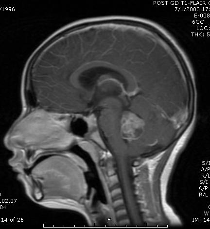 Diagnosis of Pediatric Brain Tumors Presentation Related to Tumor Location: Posterior Fossa - Cerebellar