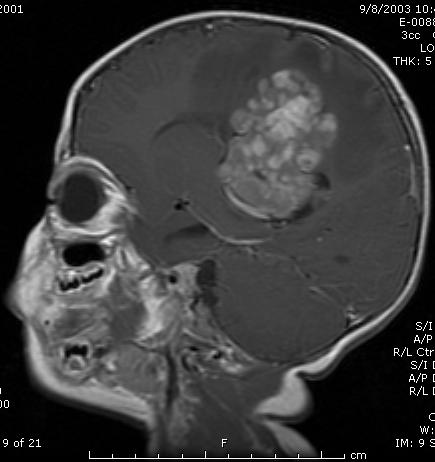 Diagnosis of Pediatric Brain Tumors Presentation Related to Tumor Location: Cerebral Hemispheres