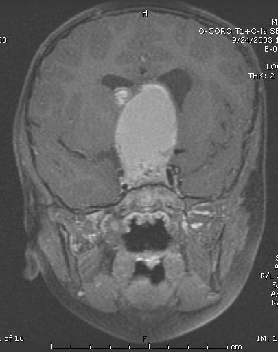 Diagnosis of Pediatric Brain Tumors Presentation Related to