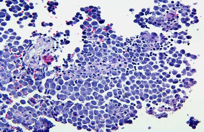 Endoscopic Tumor Biopsy: Case #1 Pathology: germinoma Treatment: chemotherapy and involved field