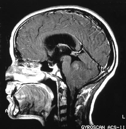12 year old girl presented with morning headaches 4/2009 Treated for sinusitis with antibiotics, headaches continued, associated with intermittent vomiting and neck pain