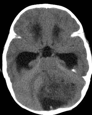 Case #3 5 month old boy presented with intermittent twitching, sometimes