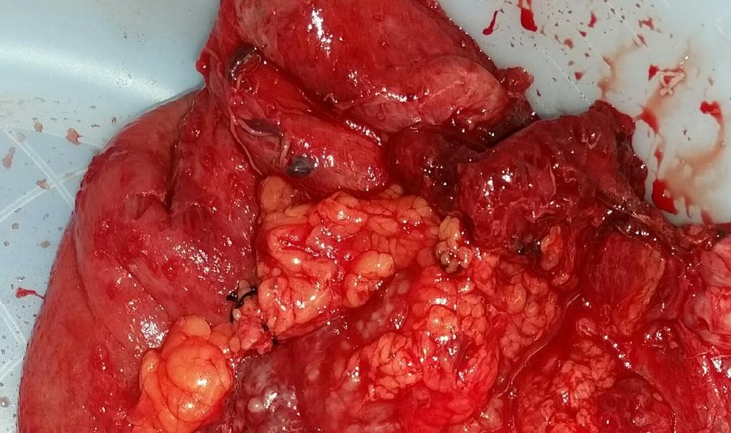 A 52 year old with free air has a perforated sigmoid cancer