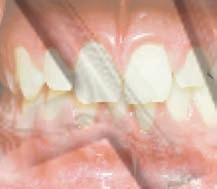 Initial Gum Disease