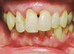 (gums and underlying