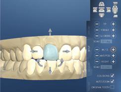 5 After validation of your 3D setup, your custom IdealSmile ALIGNER system is fabricated and delivered to your office.