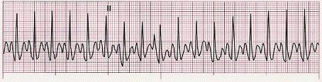 Sinus rhythm at a rate of 24 to 81 beats/min with an episode of sinus arrest management of sinus arrest. 8. Identify the following rhythm (lead II): Sinus tachycardia at 140 beats/min 9.