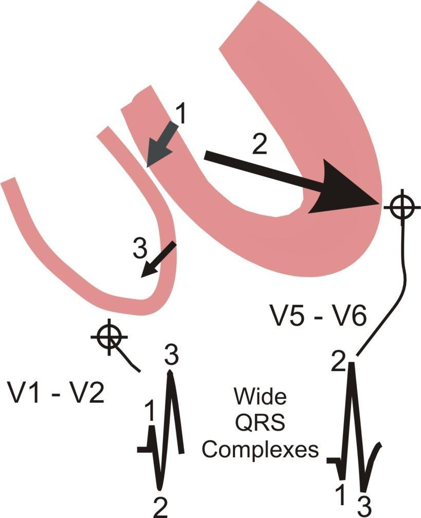 Right Bundle Branch Block (RBBB): 1. Septum depolarization occurs first inscribing an initial upward deflection in V1 - V2 and a small downward deflection in V5 - V6. 2.