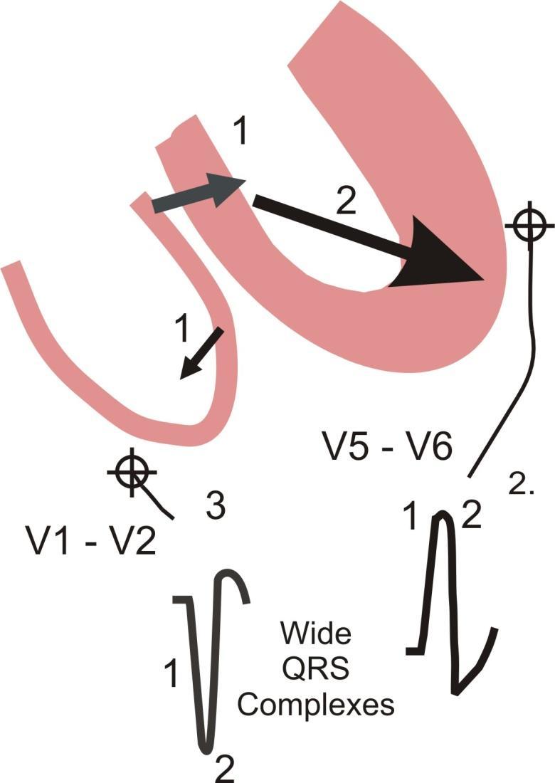 Left Bundle Branch Block (LBBB): 1. Depolarization enters the right side of the right ventricle first and simultaneously depolarizes the septum from right to left.