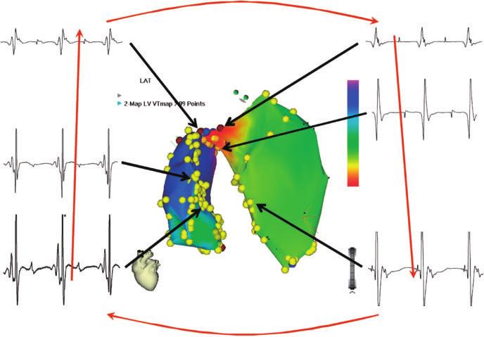 Nogami A Purkinje-related arrhythmias VT-CL: 360 ms 186 ms LAF LPF -183 ms 1.29 cm RB Figure 7 Electroanatomic mapping during the reverse common form of bundle branch reentry.