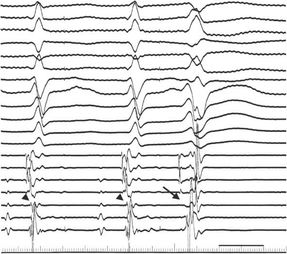 (A) During polymorphic VT, a diastolic Purkinje potential (Pd) and presystolic Purkinje potential (Pp) were recorded from the left ventricular septum.