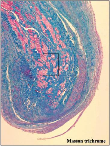 APM: anterior papillary muscle, LA: left atrium, MV: mitral valve, PPM: posterior papillary muscle, SMVT: sustained