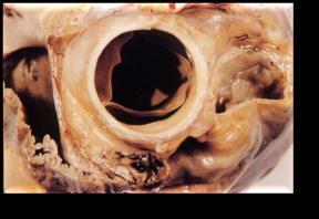 Divides into left anterior descending and circumflex arteries Left anterior descending (LAD) supplies:
