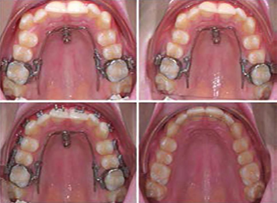 [18,19] This has resulted in a tendency to favor purely intra-oral distalization appliances with minimal need for patient cooperation.