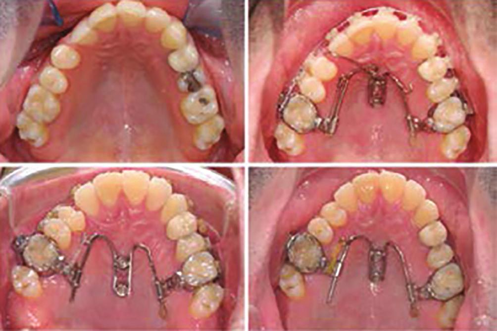 The two major treatment approaches are space closure or space opening to allow prosthodontic replacements either with a fixed prosthesis or single-tooth implant.