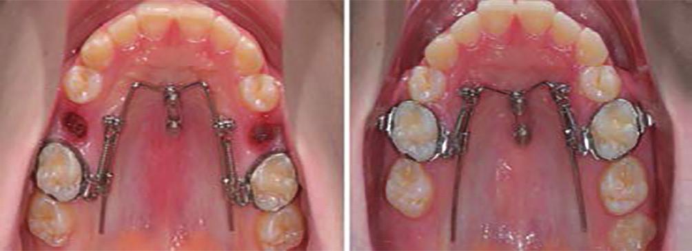 [32] In many cases, space closure to the mesial seems to be the favorable treatment goal, since treatment already can be completed as soon as the dentition is complete.