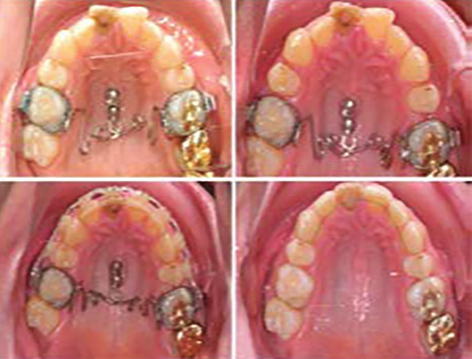 [34,35] The more mesial the missing tooth is, the higher will be the demands for anchorage quality, especially in asymmetric cases with a midline deviation.