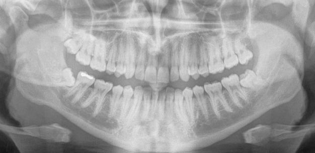 Patient information leaflet about Lower Wisdom Teeth (3