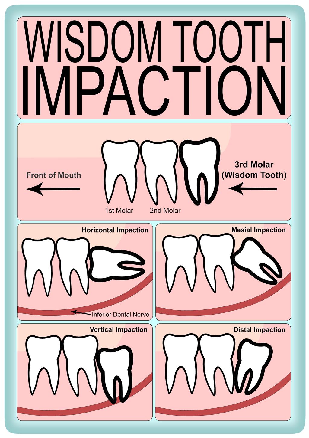 Issues with lower wisdom teeth Wisdom teeth are the last teeth to develop in your jaws, often there is not enough space for them to erupt into the correct position like the other teeth in your mouth.