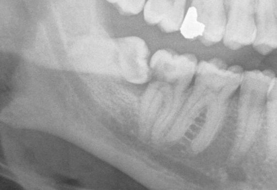 A horizontal wisdom impacted teeth. There is early decay in the tooth in front. Your dentist may be able to repair this tooth A horizontal impacted wisdom tooth.