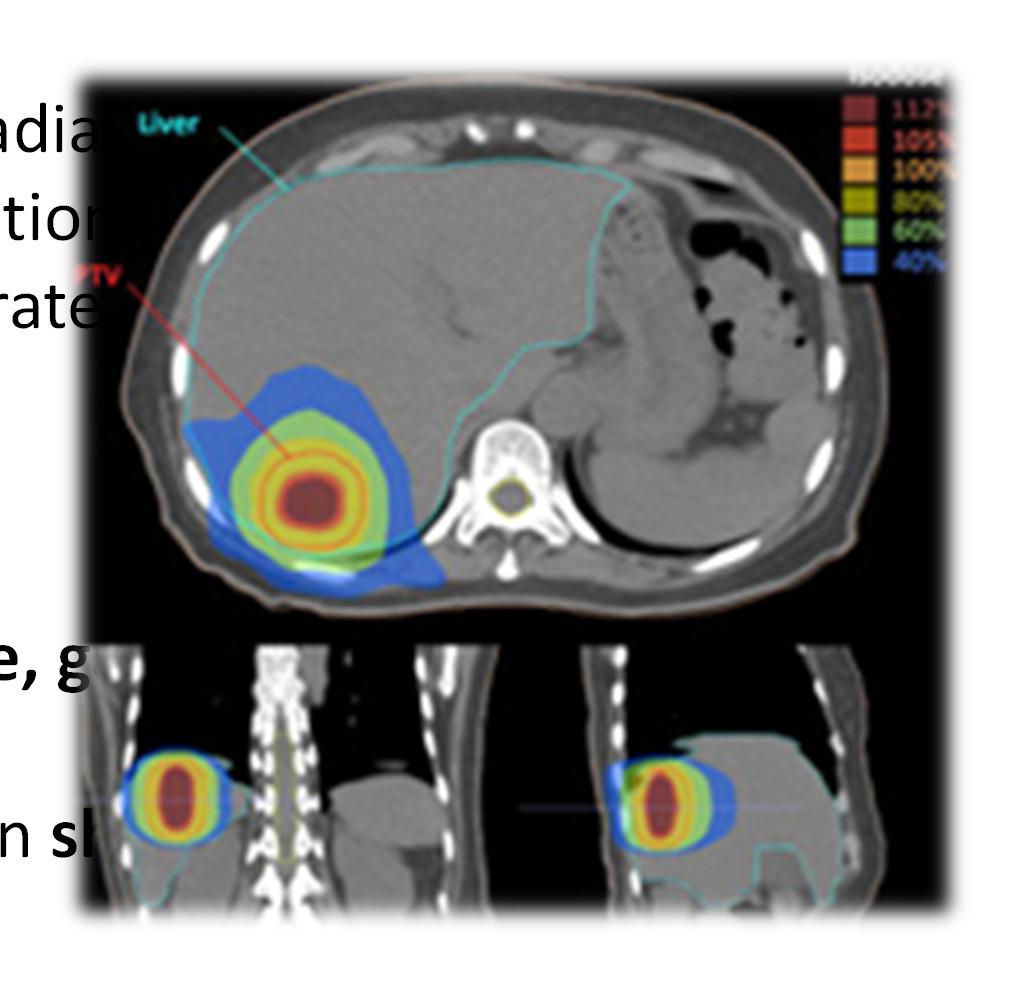 Hi-tech treatments for liver metastases IMRT delivered with MLC Segmental IMRT (step-and-shoot) -Gantry does not move during irradiation -Each collimator shape is a subfield (segment) Dynamic IMRT
