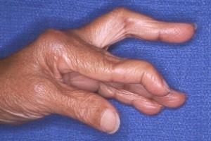 Swan-Neck Deformity DIP Flexion and PIP Extension Typically Requires