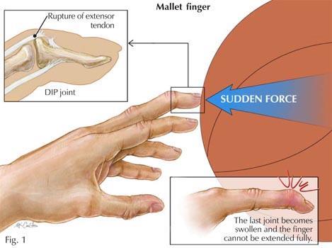 Mallet Finger Avulsion of distal slip of extensor tendon Rapid forced flexion of distal phalanx Dec.