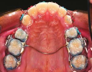 Biomechanical Considerations in the Correction of Anterior Open Bite plan, the maxillary arch would be leveled segmentally, and a space for the surgical incision would be opened between the canines