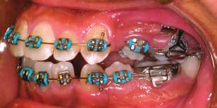 Segmental posterior intrusion mechanics were continued in the maxillary arch while the lower canines were retracted using 150g nickel titanium retraction springs.