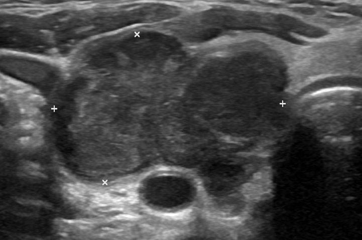 Ultrasound CT Neck Include lateral neck when dealing with carcinoma Usually not needed unless tracheal