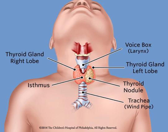 Thyroid nodules 20 per 1000 children nodules in children carry a greater risk of malignancy compared to those in adults (22% 26% versus 5% 10% in most series) Thyroid cancer patients < 20 years = 1.