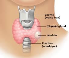 Thyroid nodules less common among children than adults but more likely to be malignant Estimates from US and postmortem examination 1% 1.