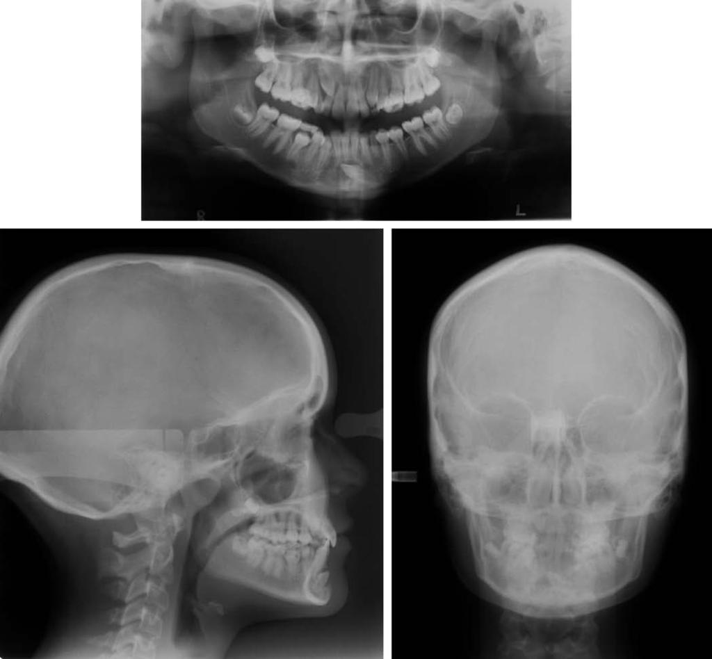 TRANSMIGRATED MANDIBULAR CANINE 329 FIGURE 1. (a) (c) Pretreatment panoramic, lateral cephalometric, and posteroanterior radiographs.