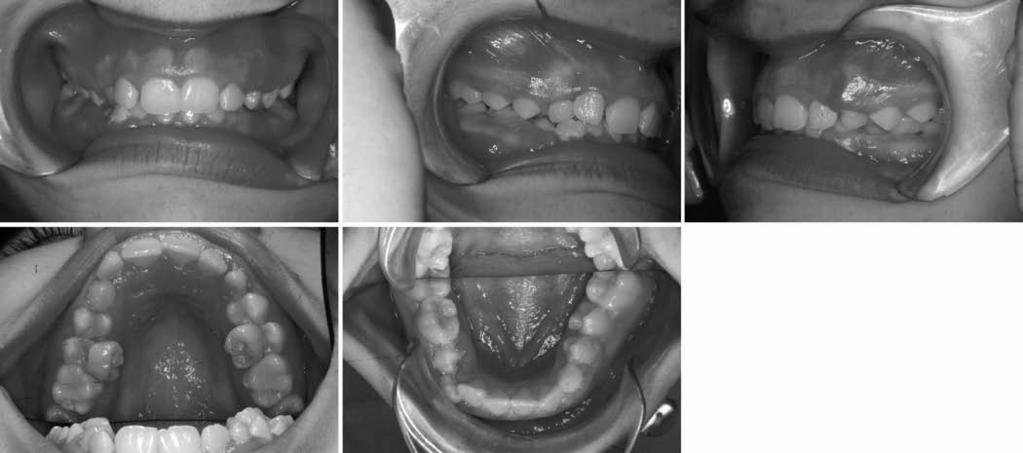 Surgical removal of the left transmigrated canine and maintenance of the mandibular left primary canine (tooth #73) to preserve alveolar bone height and width, until the patient would be ready for an
