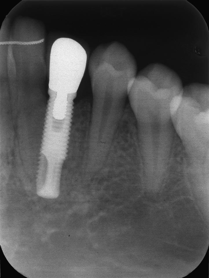 332 REBELLATO, SCHABEL FIGURE 5. Endosseous implant placed at site of extracted mandibular left canine. the chance of contact between the apex of tooth #12 and the crown of tooth #13.
