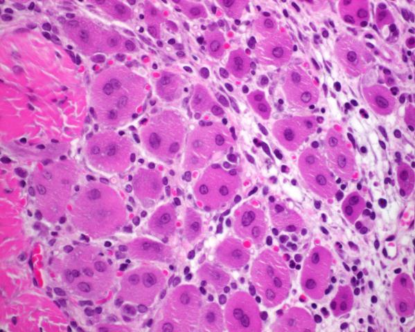 multiple nuclei along with increased sarcoplasmic basophilia (black