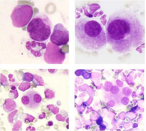Megakaryocytic lineage Morphological abnormalities Cutoff values Variable weighted