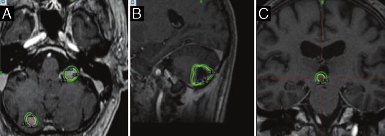 Radiosurgery for brain metastases using Gamma Knife versus LINAC FIG. 6.