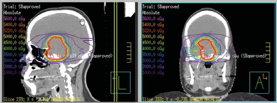 radiotherapy Conventionally/classically fractionated (LINAC-based) 45 Gy McCoullough WM