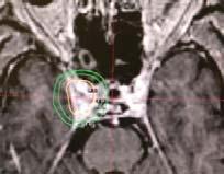 Stereotactic radiosurgery Stereotactic radiosurgery Single session radiosurgery (Gamma knife, Cyberknife, LINAC) Nonfunctioning: 12-20 Gy Functioning: 15-30 Gy Single session radiosurgery (Gamma