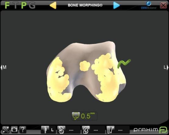 Femoral Acquisitions Bone Morphing Validation Checks for Accuracy of 3D Model