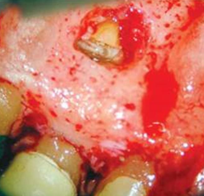 Debridement: After the root-end filling is inserted, the tissues are irrigated with
