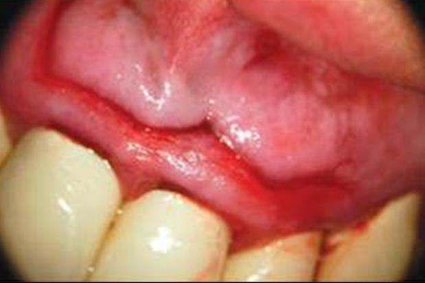 9- Closure of the surgical site: a) Flap repositioning: The interdental papillae are first repositioned to their