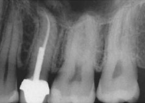 Indications for surgical endodontics 1- Failed conventional endodontics 2- Conventional endodontics is impracticable: 2.