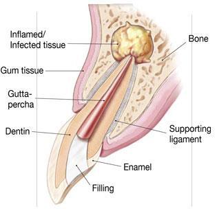 Peri-radicular surgery: Apicectomy/ apico-ectomy
