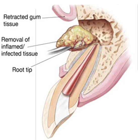 flap, curettage of the apical granulation