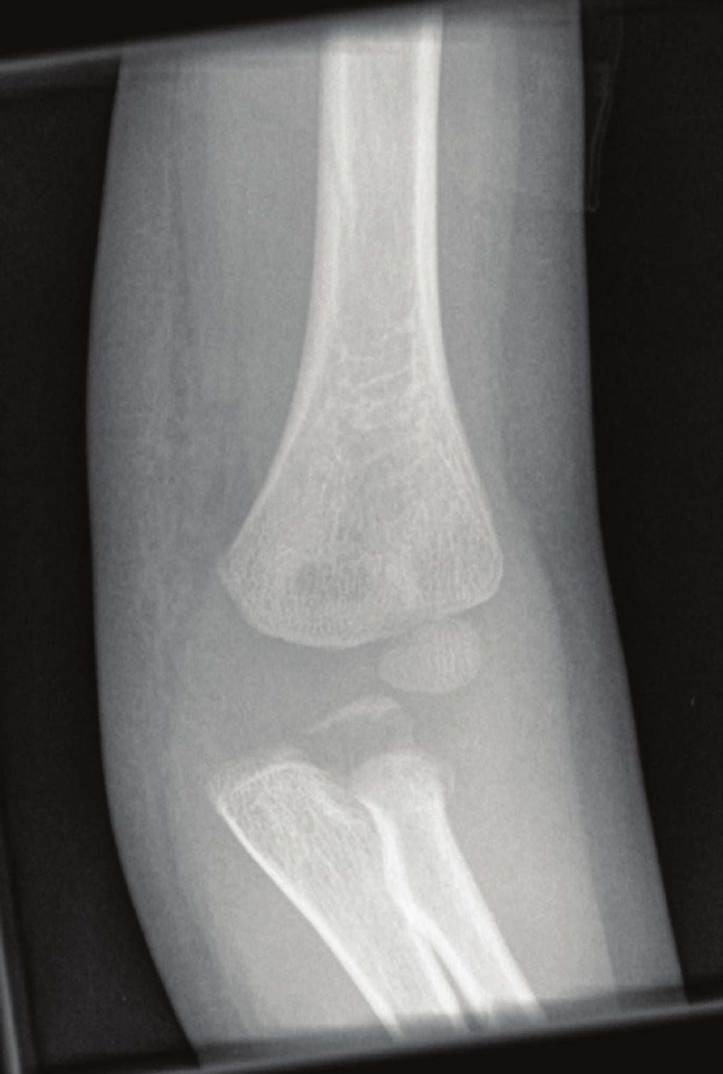 Radiographs (Figures 5 and 6) demonstrated full union of the olecranon fracture and elbow joint articular congruency. 3. Discussion Monteggia fractures are uncommon and account for about 0.
